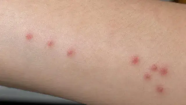 Small red bed bug bite welts arranged in a line and cluster on human skin